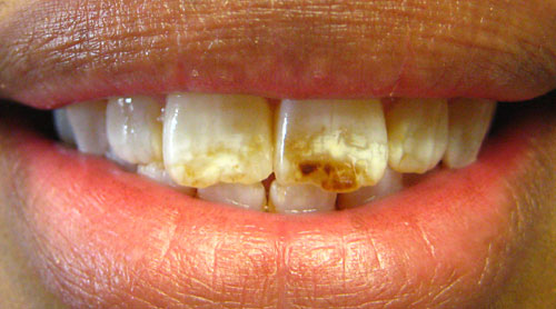 yellowest teeth in the world