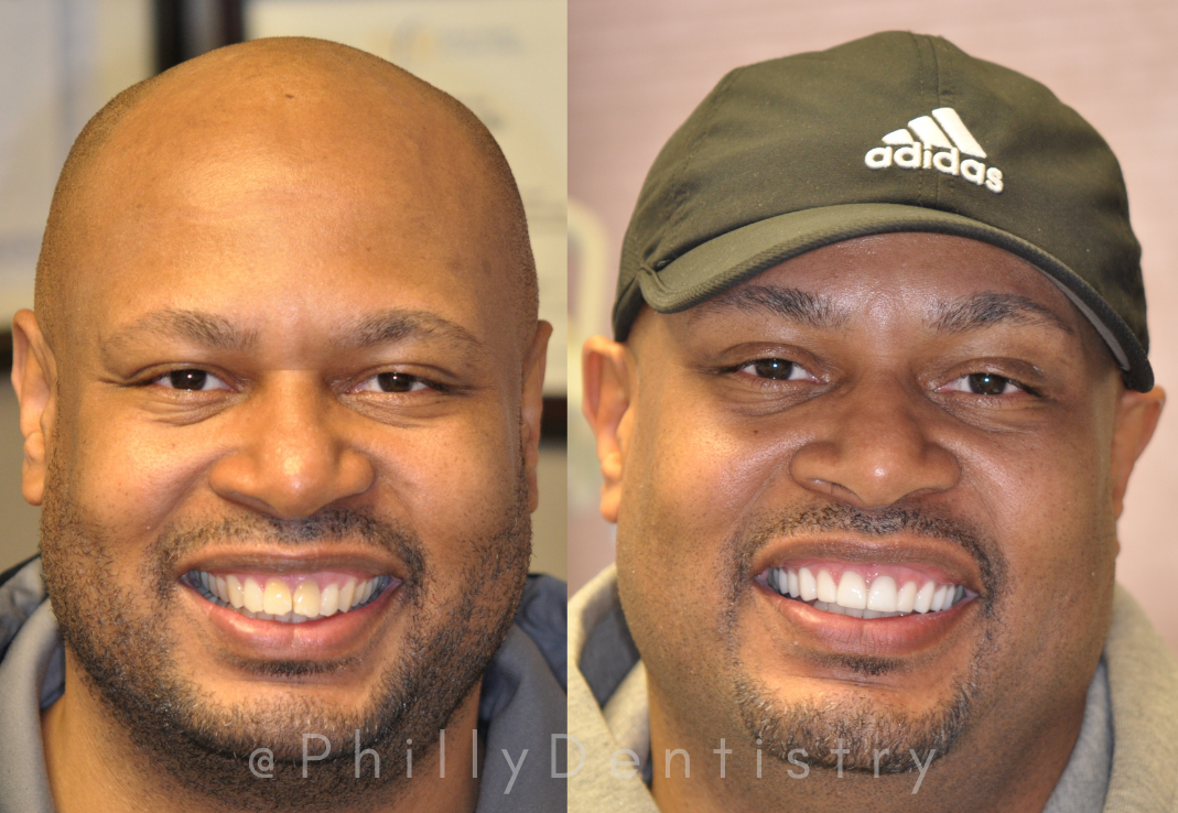 veneers before and after buck teeth