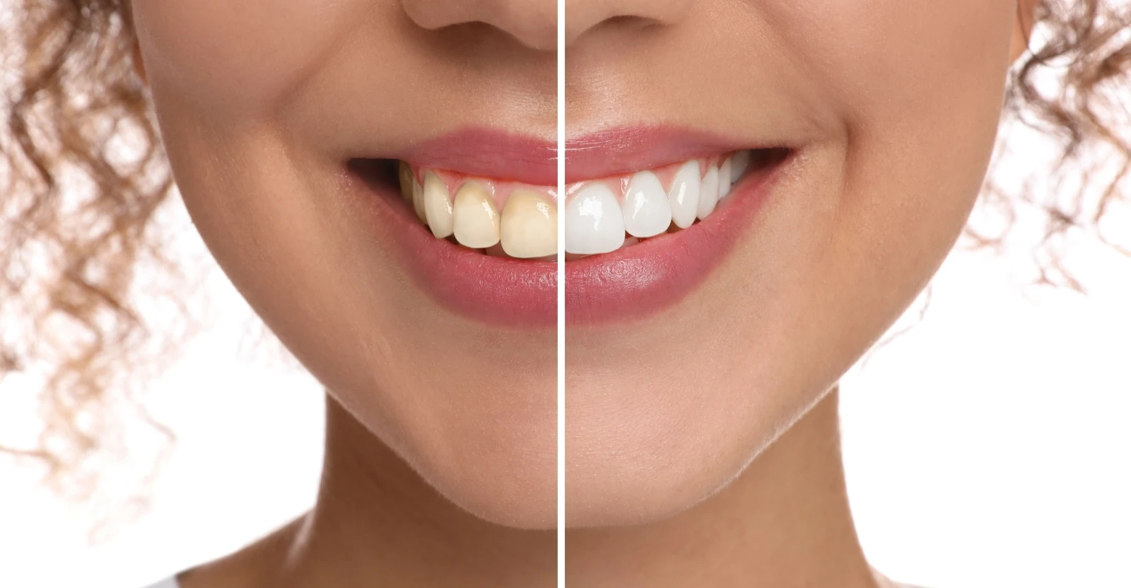 Before and After Cosmetic Dentistry photos