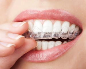 invisible braces invisalign pix