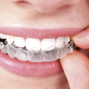 invisalign