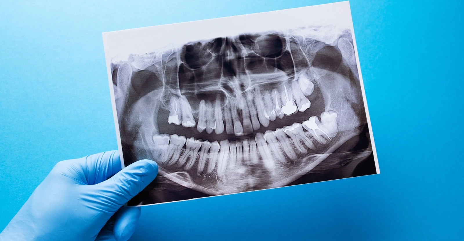 Dental X-Rays: What Are They Looking for?