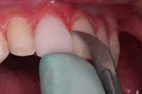 composite veneers