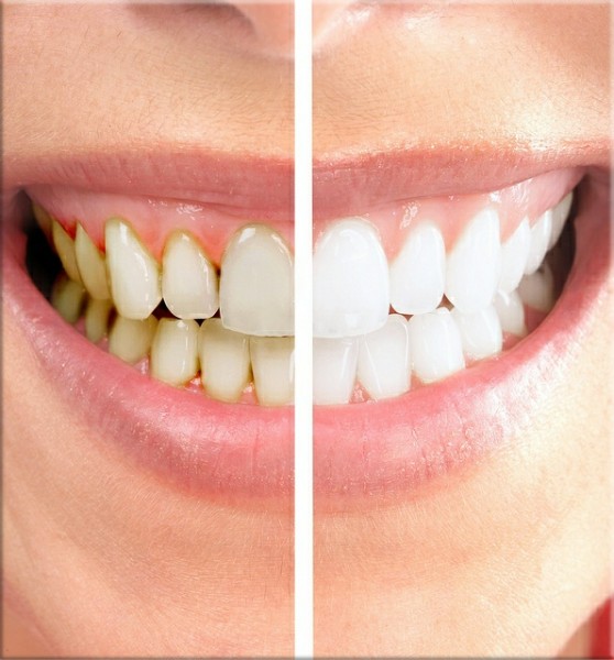 porcelain-veneers-west-pennant-hills