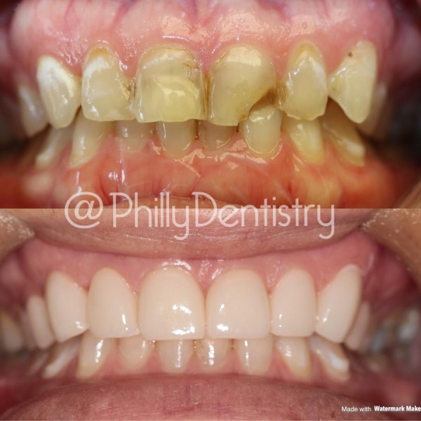 veneers & whitening