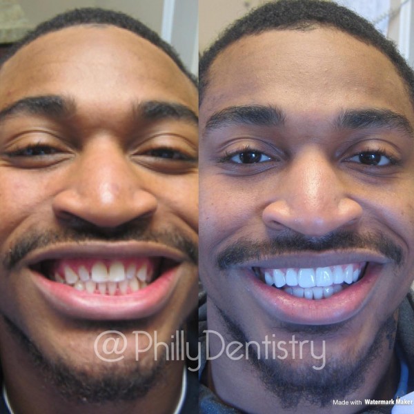 Jaelen Strong Veneers