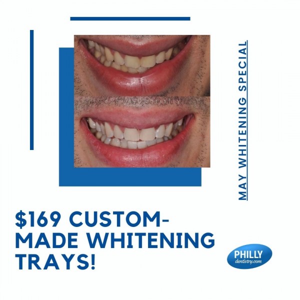 May whitening special