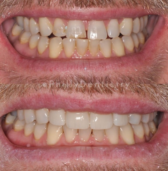 watermarked teeth USED