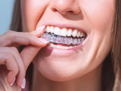 Invisalign 6-8 weeks - Philly Dentistry