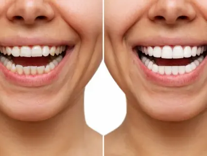 A Permanent Solution For Beautiful Teeth - Philly Dentistry