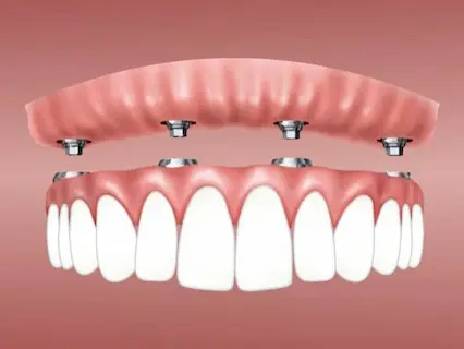 snap on dentures