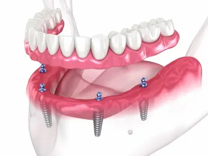 full mouth implants