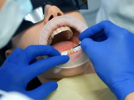 How Most Types of Porcelain Veneers Are Applied - Philly Dentistry