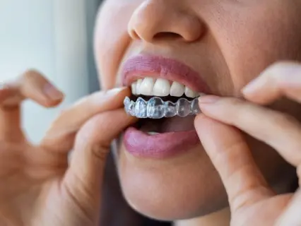 How does Invisalign straighten my teeth - Philly Dentistry