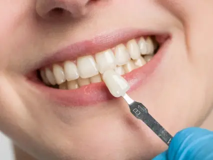 More Information About Porcelain Veneers - Philly Dentistry 