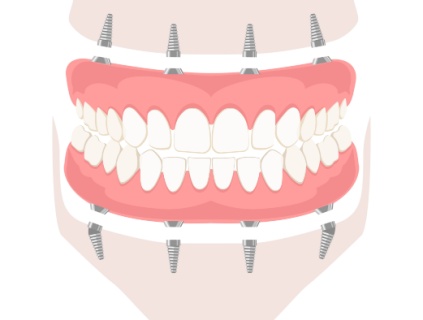 full-mouth dental implants