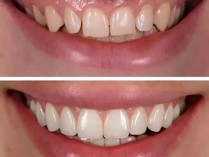 Most Common Types of Porcelain Veneers - Philly Dentistry