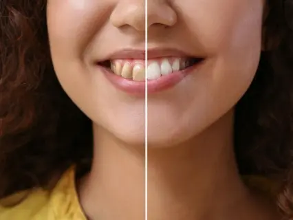 Typical Cosmetic Flaws of a Candidate for Veneers - Philly Dentistry