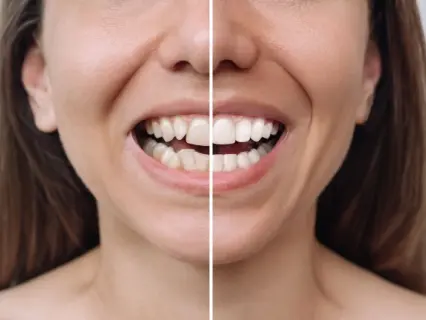 What problems do porcelain veneers correct - Philly Dentistry