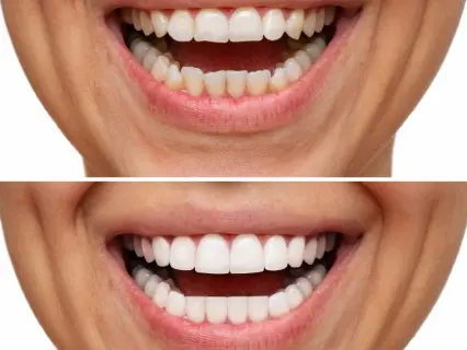 Why the Cost of Porcelain Veneers Is a Worthwhile Investment - Philly Dentistry