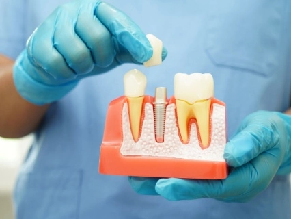 dental implants model 