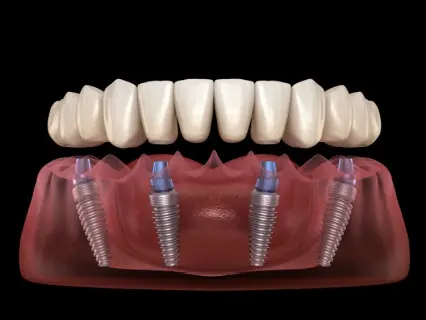 all-on-4 dental implants