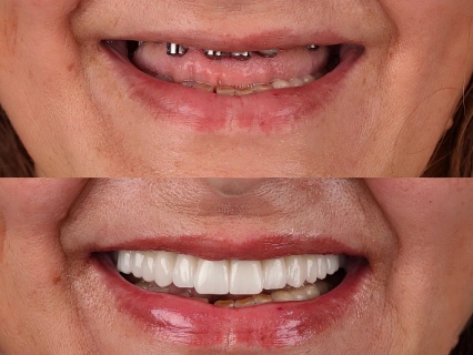 all-teeth dental implants