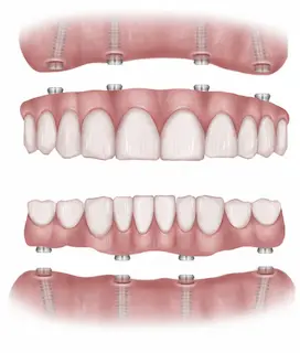 all-teeth dental implants