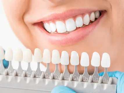 cosmetic teeth whitening 