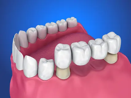 dental bridge