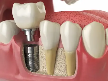 dental implants procedure