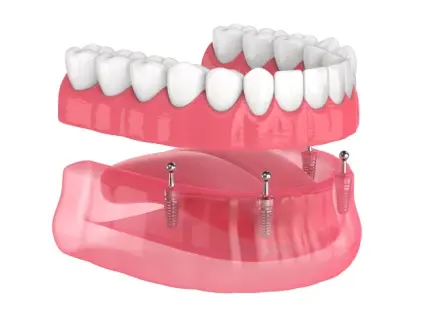 denture implants