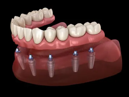 denture implants