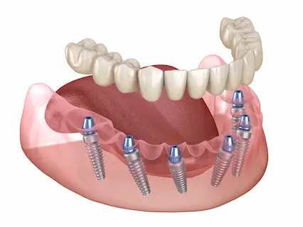 all-teeth dental implants