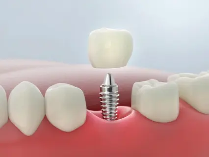 teeth implants