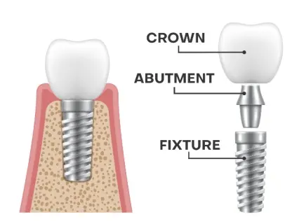 dental implants durability