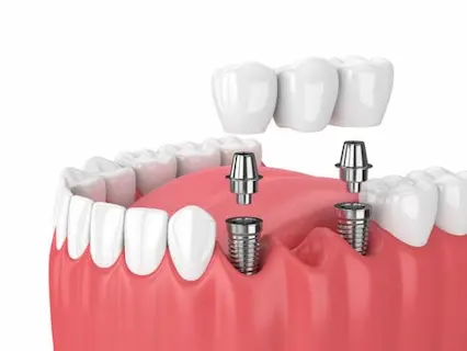 multiple-teeth dental implants 