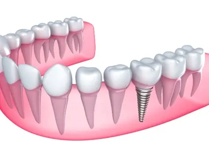 single-tooth dental implant