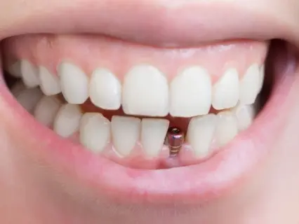 single tooth dental implant