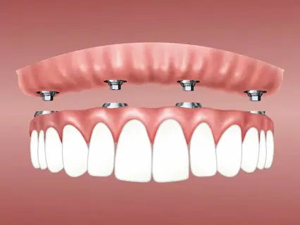 denture implants