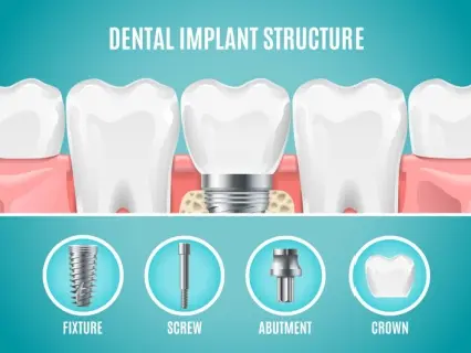 dental implant structure