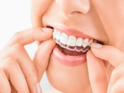 at-home teeth whitening 