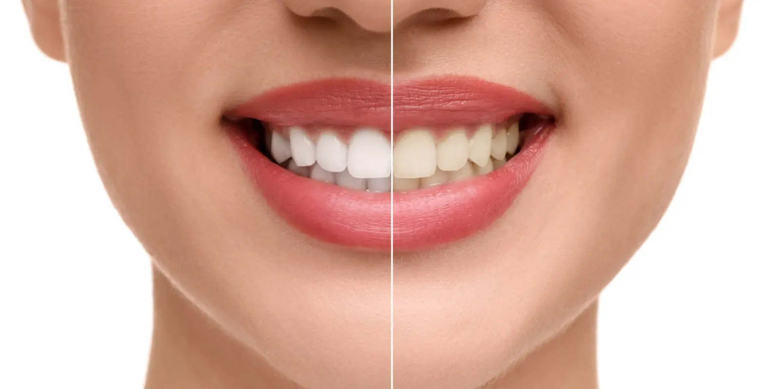 tooth whitening