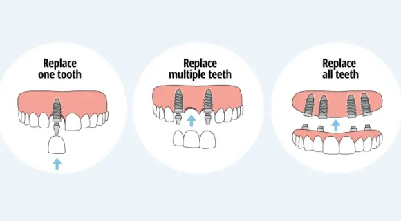 types of teeth implants