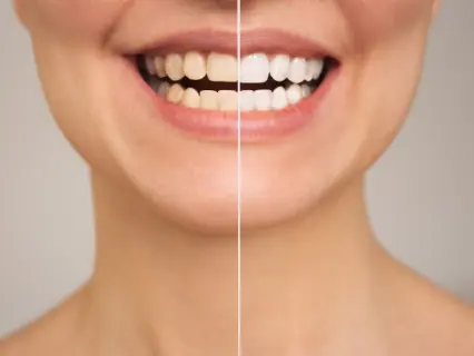 zoom teeth whitening