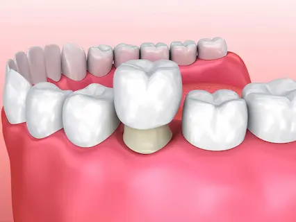 dental crowns 