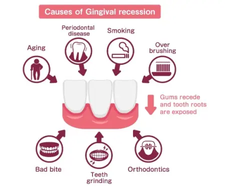 causes of gum disease