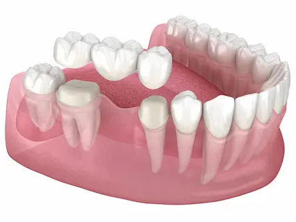 dental bridges