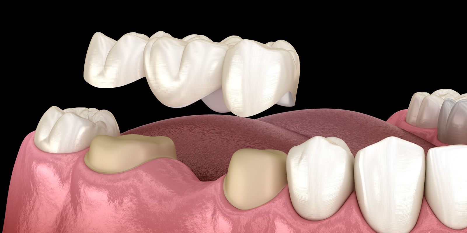 dental bridges