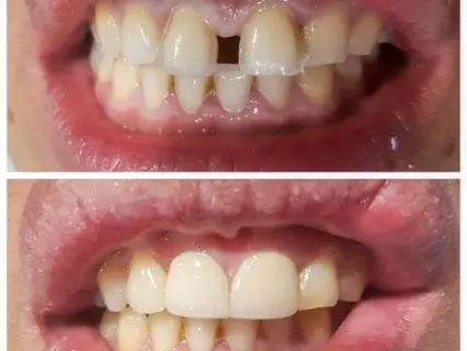 cosmetic teeth bonding